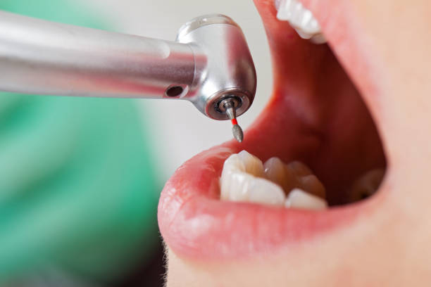 Best Urgent Care for Lost Fillings or Crowns in Windom, MN